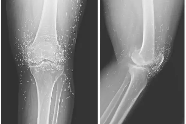 В Южной Корее врачи обнаружили золотые частицы в колене пациентки
