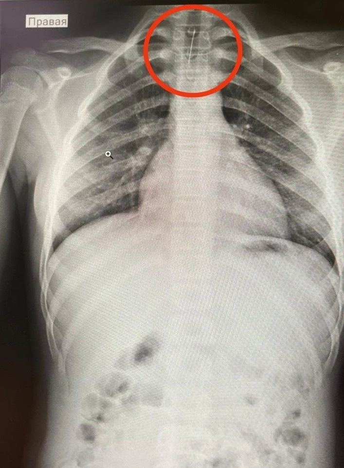 Подмосковные врачи спасли девочку, проглотившую иглу